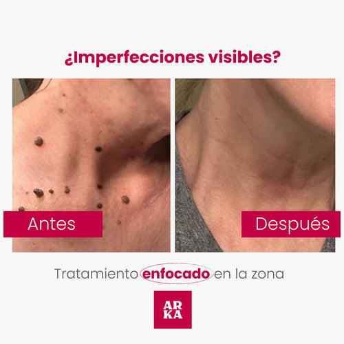 Eliminador de Verrugas